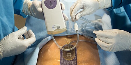 PREVENA™ Therapie
