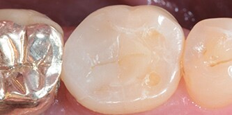 Foto der endgültigen Restauration
