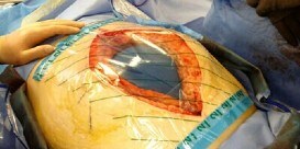 Versorgung des offenen Abdomens
