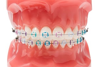 Dental model, showing multi-colored Clarity Advanced Ceramic Braces