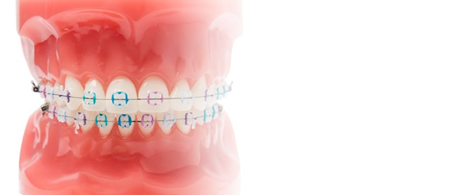 Dental model, showing multi-colored Clarity Advanced Ceramic Braces