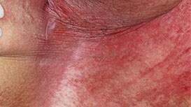 Intertriginöse Dermatitis
