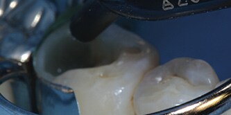 Filtek One Bulk Fill wird in die Zahnkavität eingebracht

