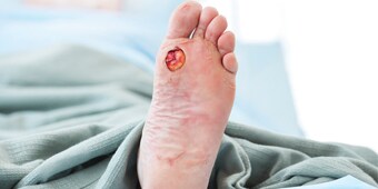 Diabetisches Fußulcus

