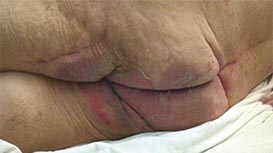 Inkontinenz-assoziierte Dermatitis
