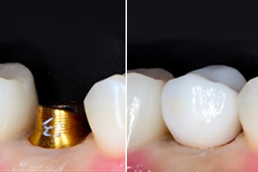 Nahaufnahme von Implantat und Restauration

