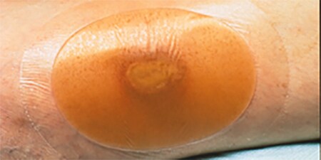 3M Tegaderm Hydrocolloid
