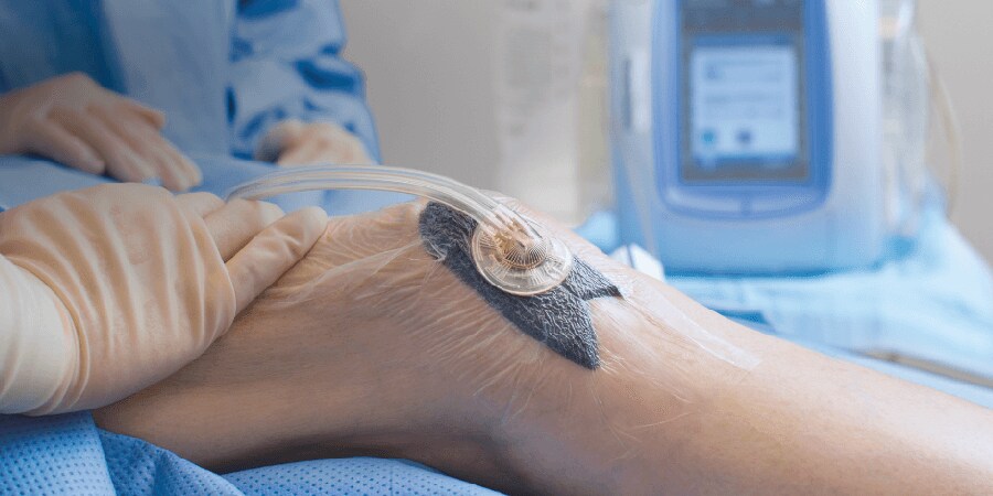 Unterdruck-Wundtherapie (NPWT)
