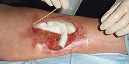3M Tegaderm Alginate
