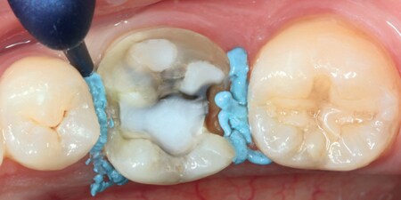 Interproximale Feuchtigkeitskontrolle der subgingivalen Präparationsgrenze
