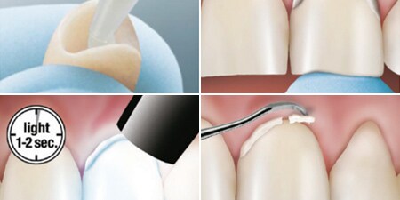 3M RelyX Unicem 2 Schritt-für-Schritt-Anleitung
