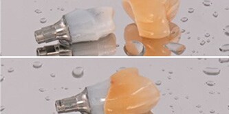Es wurde ein patientenspezifisches zweiteiliges 3M™ Lava™ Plus Zirkonoxid-Abutment hergestellt.
