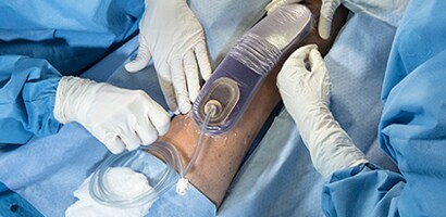 Chirurg im OP verwendet die Prevena Therapie
