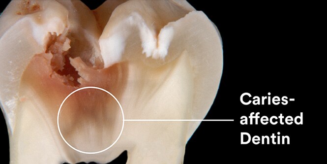 von Karies betroffenes Dentin
