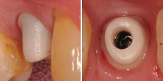 Intraorale Situation mit eingesetztem Zirkoniumoxid-Abutment.
