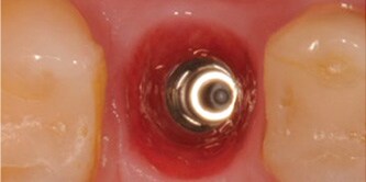 Der Zahn wurde extrahiert und ein Straumann® Bone Level Implantat eingesetzt.

