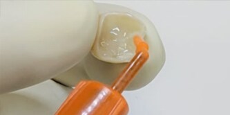 Anwendung von 3M RelyX Universal Kompositzement.
