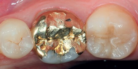 Insuffiziente und perforierte Teilgusskrone aus Goldlegierung auf dem ersten unteren Molaren
