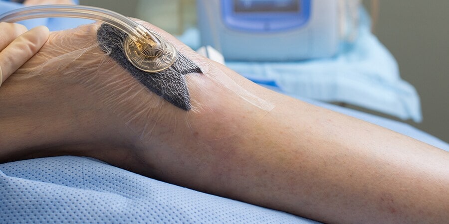 Arzt, der das V.A.C. ® GRANUFOAM™ Dressing am Knie eines Patienten anlegt
