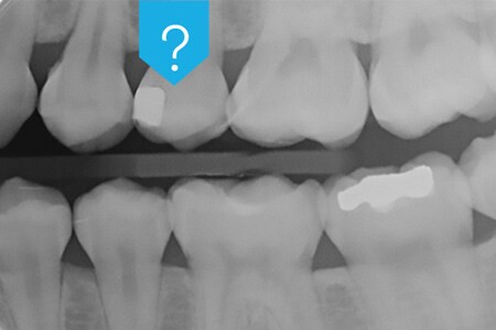 Röntgenbild der Zähne mit Röntgenopazität des Dentalklebers
