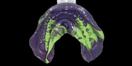 Endgültige Abformung mit 3M Impregum Super Quick Abformmaterial, mit einem 3M Abformlöffel
